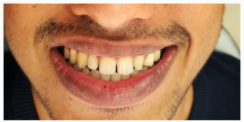 Smile before treatment at New Smile Dental Care
